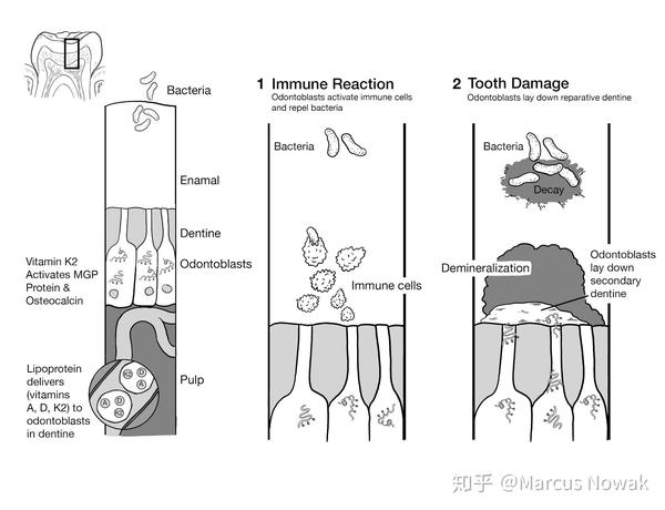 这些成牙本质细胞就像是一个突起,可以监视牙釉质小管和牙本质小管