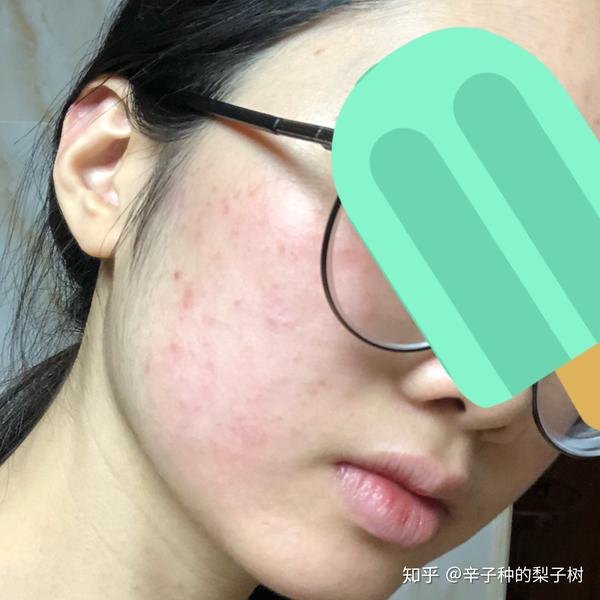 脸上长了很多又红又痒逆光疹子,有些透明的尖头看起来