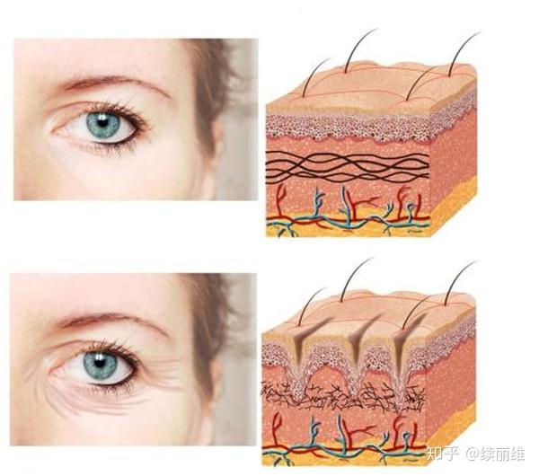 干纹,细纹(菲洛嘉眼周注射)