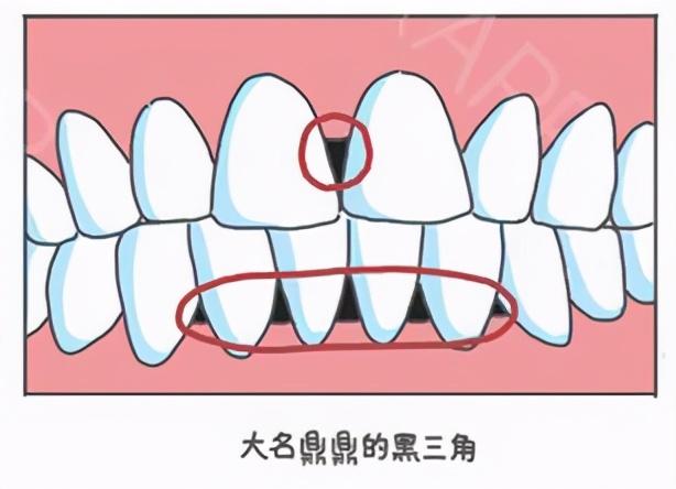 牙齿出现黑三角真不可逆的吗听听医生怎么说