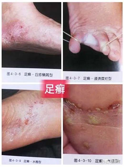 脚足癣(俗名"香港脚,脚气,系真菌感染引起,其皮肤损害往往