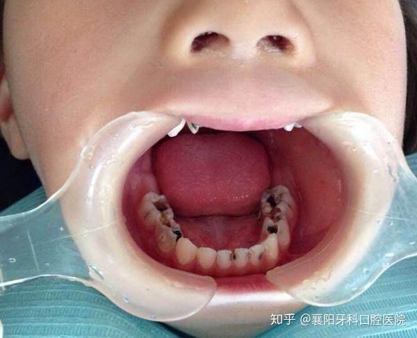 所以长此以往,我国的很多儿童都有龋齿问题,也就是我们常说的蛀牙!