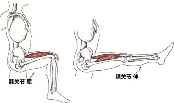 不解决它,美腿翘臀只是妄想——膝超伸