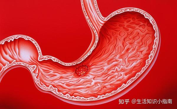 胃酸过多胃病们都会不期而至若有做好4件事就不用担心