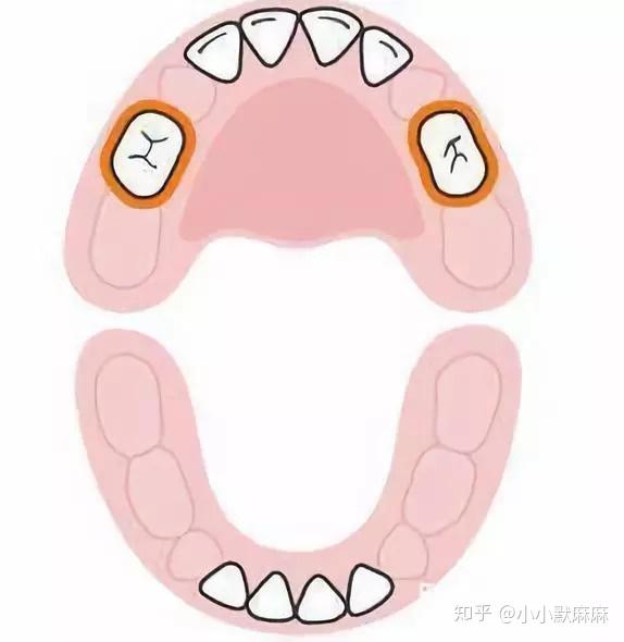 14-18个月,下齿槽长出了两颗臼齿(下颌第一乳磨牙)