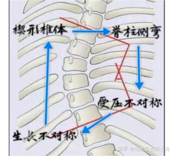 脊柱侧弯是如何形成的?