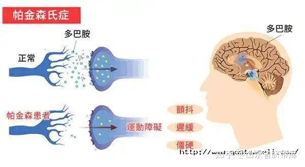 帕金森病的治疗现状