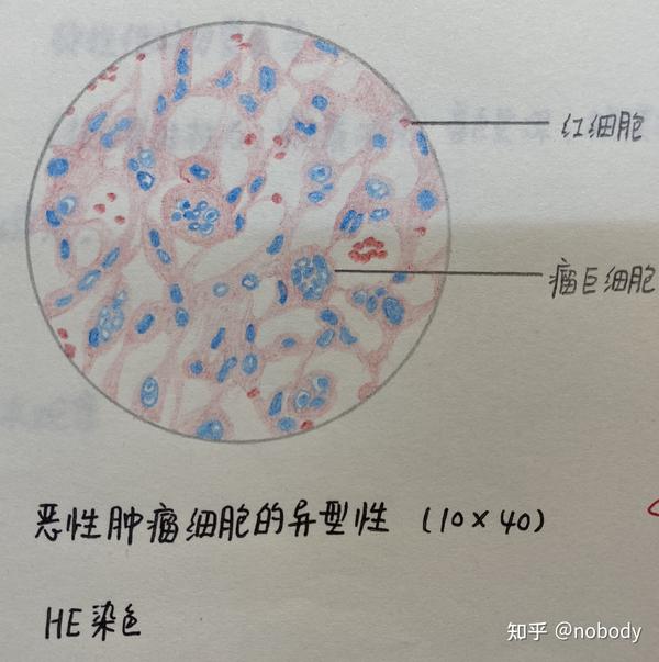 3.恶性肿瘤细胞的异型性