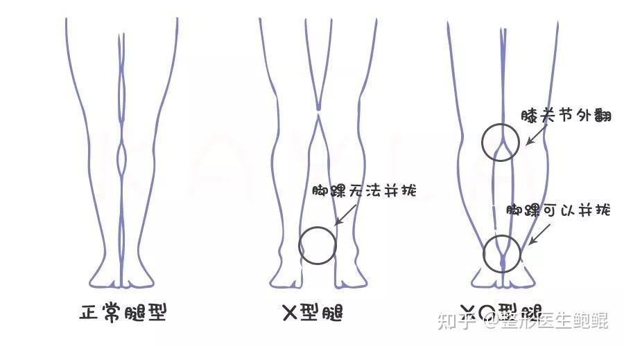 有没有什么改善x型腿的方法吗