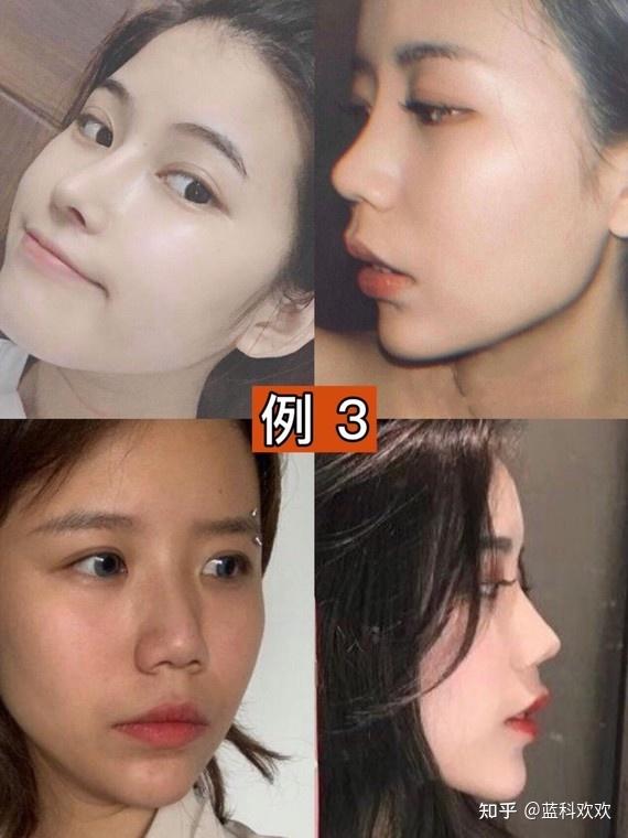 3,鼻子高度适可而止,鼻梁不是想垫多高都行,而是需要看鼻部皮肤张力