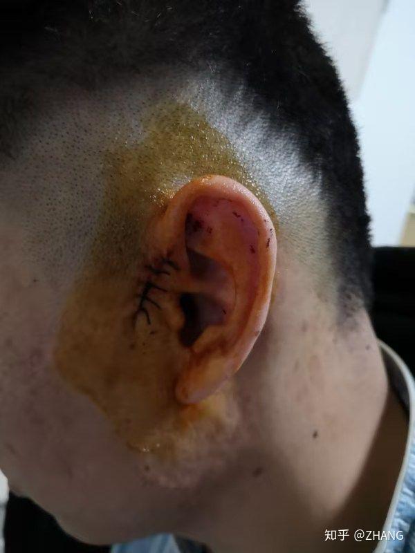 男,25,坐标长沙,先天性耳前瘘管两边耳朵都有,左耳小时候就发过炎