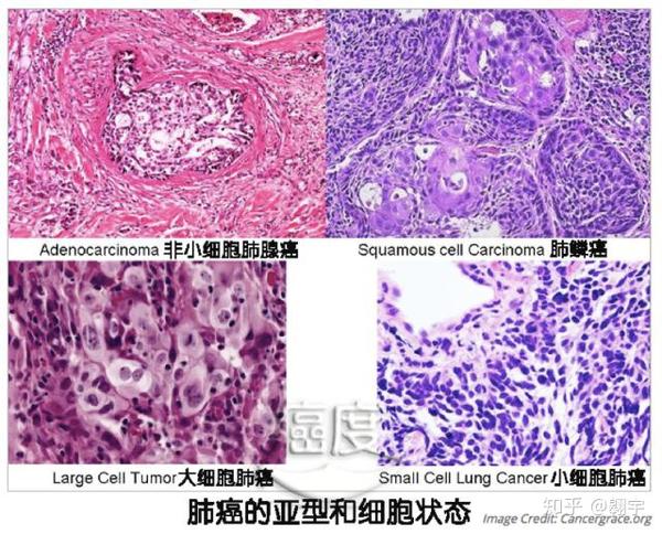 暗度陈仓的癌细胞:非小细胞肺癌转化为小细胞肺癌