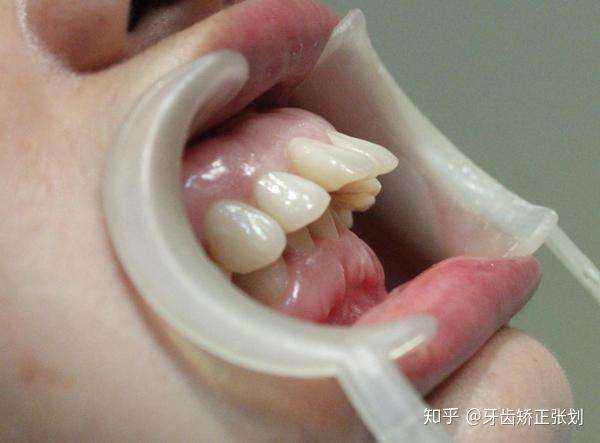 2. 骨性龅牙,一般伴随着开唇露齿,下巴后缩,露龈笑等.