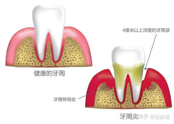 牙周炎导致牙槽骨萎缩牙根暴露牙齿松动 牙周袋内聚集大量厌氧菌