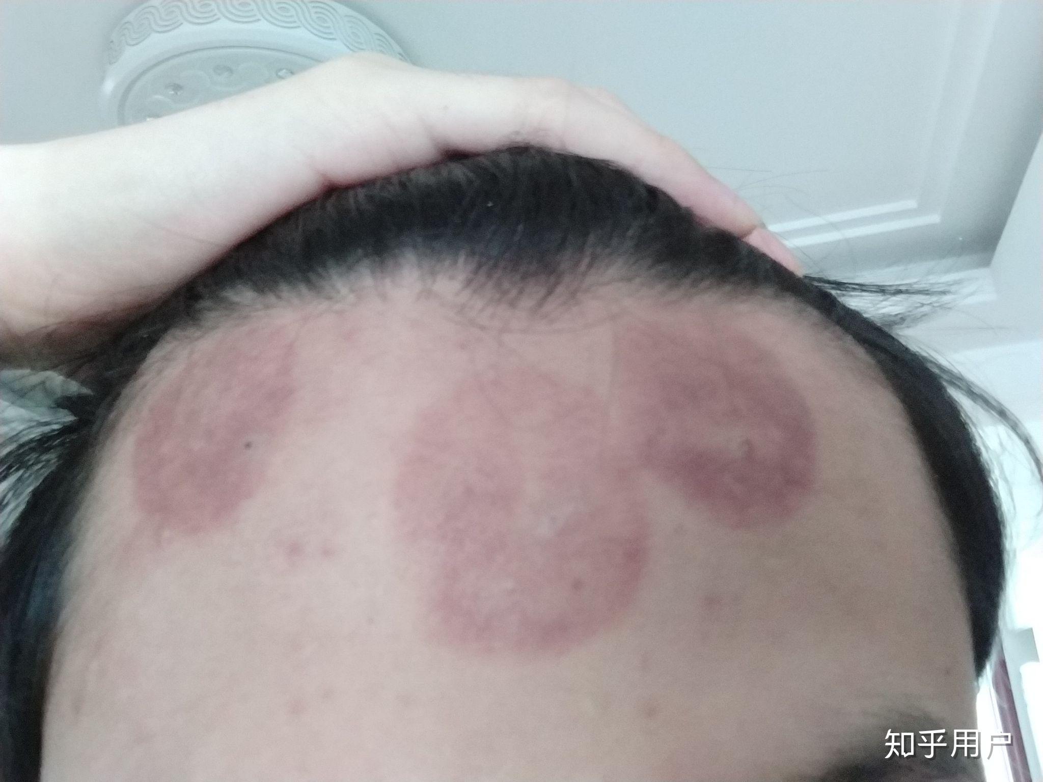 额头可以拔罐吗