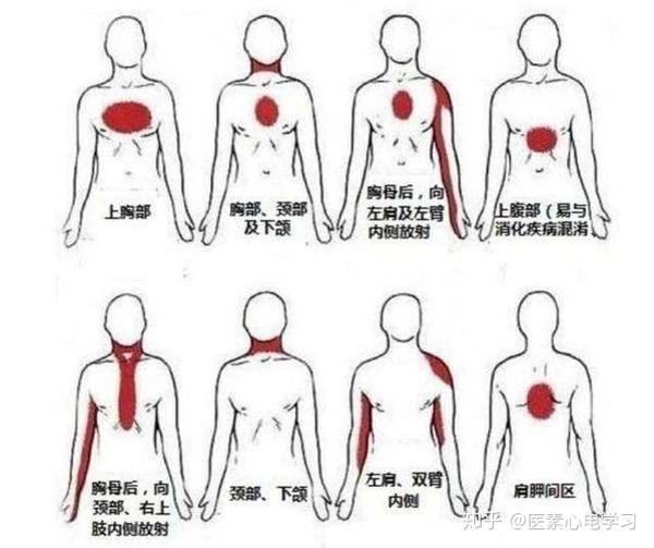 每种胸痛都跟心脏病有关吗?