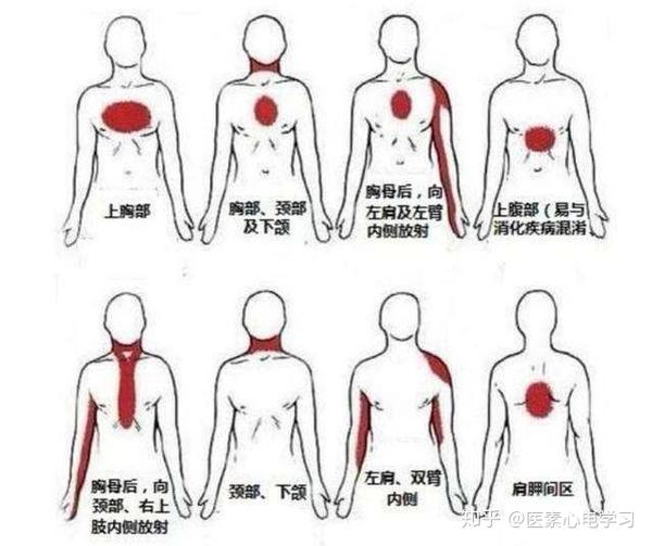 按涉及的范围分,有局部痛,广泛痛,放射痛,牵涉痛…   按部位分,有胸壁