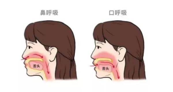 口呼吸时腭穹隆高拱 上颌骨变长,下颌后缩 下巴就显得越来越短