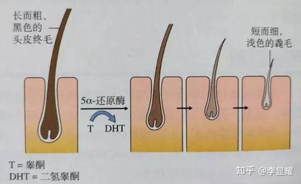 这个时候就需要赶紧采取补救措施,以免头发越来越细软,最后毛囊闭合