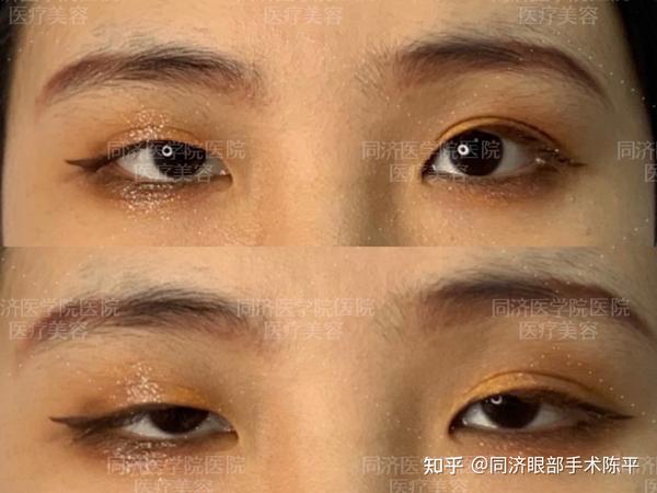 上睑下垂到底如何矫正