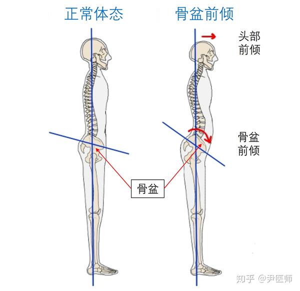 下交叉(骨盆前倾,腰椎曲度增大,假翘臀)治疗,不难.