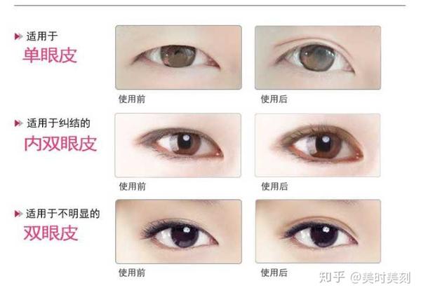 如何选择适合自己的"双眼皮贴"?