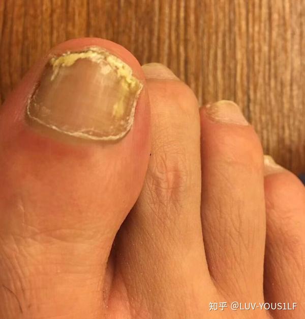 灰指甲的治疗方法总结