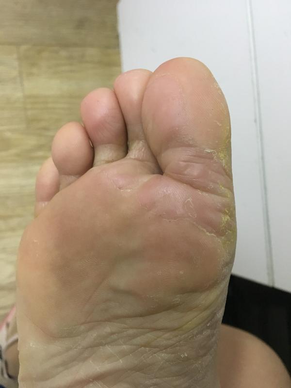 脚上老长水泡,脱皮,据说是真菌感染,请问有什么办法根治吗?