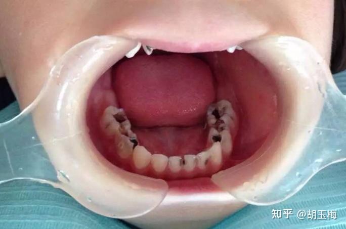 近期,很多小孩因虫牙来到我们佳士洁口腔医院就诊,一张嘴几乎没有看到