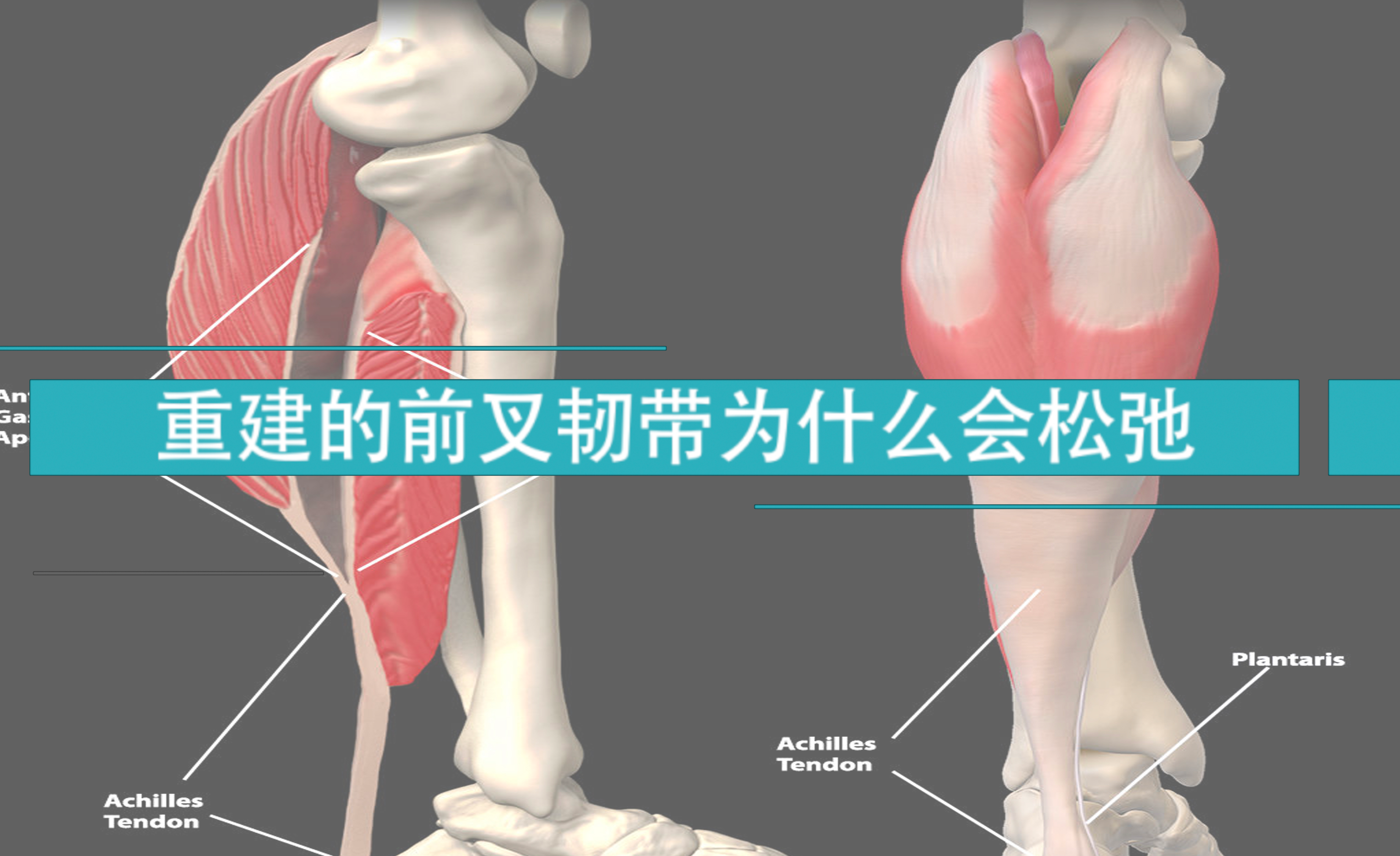 前叉韧带重建