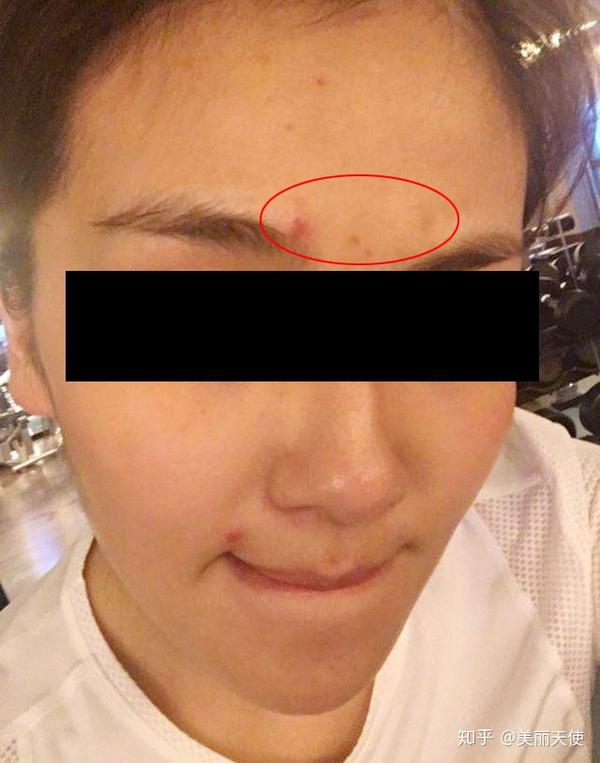 二,眉间长痘