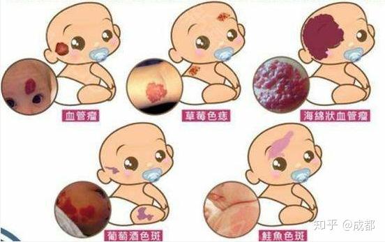 血管瘤目前乃是我国新生婴儿患病率极高的一种血管疾病,不仅让很多
