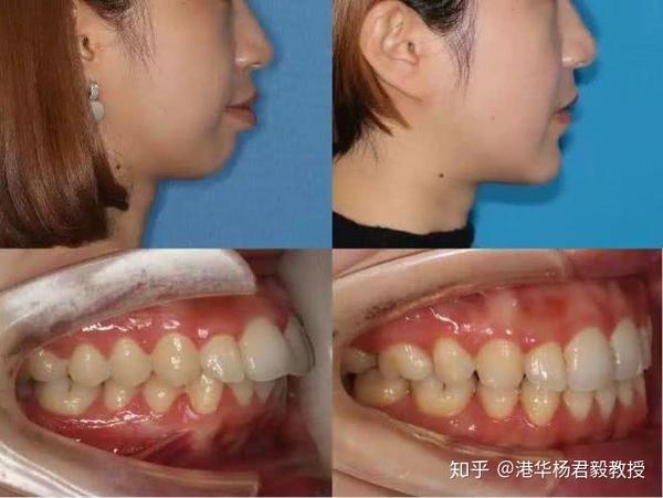 牙齿将会变得更加美观自然,咬合关系恢复正常,由于牙齿矫正器的长时间
