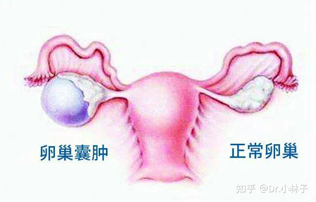 有卵巢囊肿可以做试管婴儿吗?