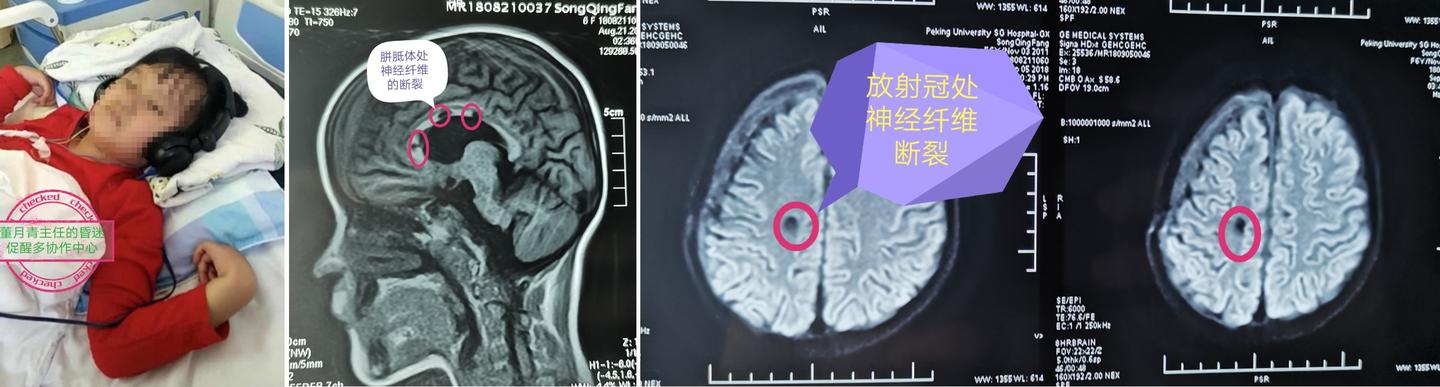 弥漫性轴索损伤(原发性脑干伤)评估和治疗