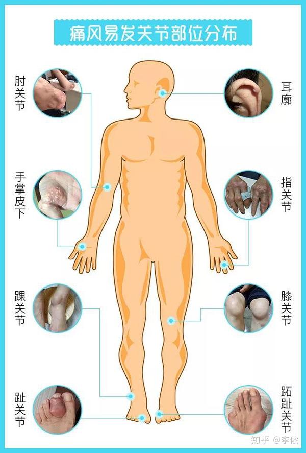 关于痛风石痛风患者想了解的都在这了