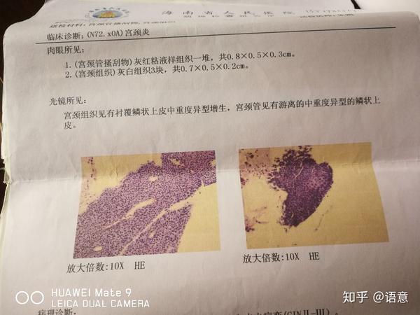 hpv16转阴之旅