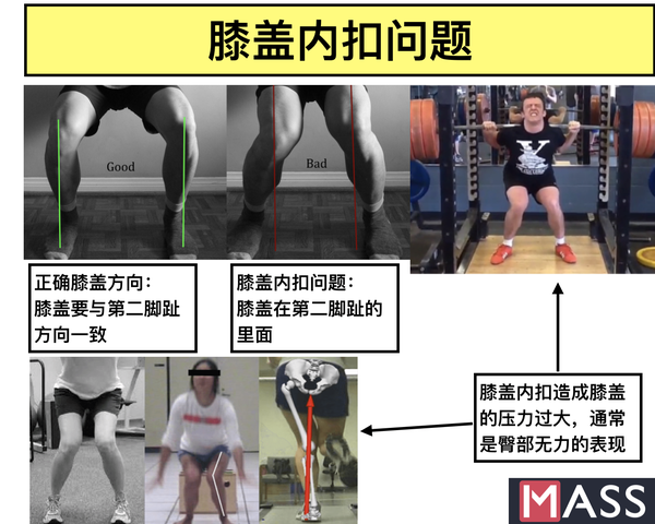 看下面这张图,当臀肌无力时,大腿会内旋,造成膝盖内扣,膝盖有扭力就会