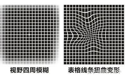 眼睛有这个情况,当心黄斑裂孔!