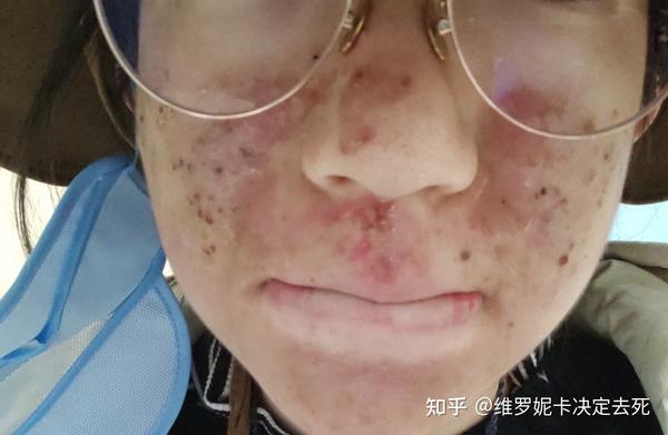 光动力治疗痤疮全记录