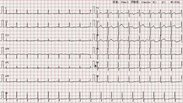心电图图库丨室上性心动过速系列