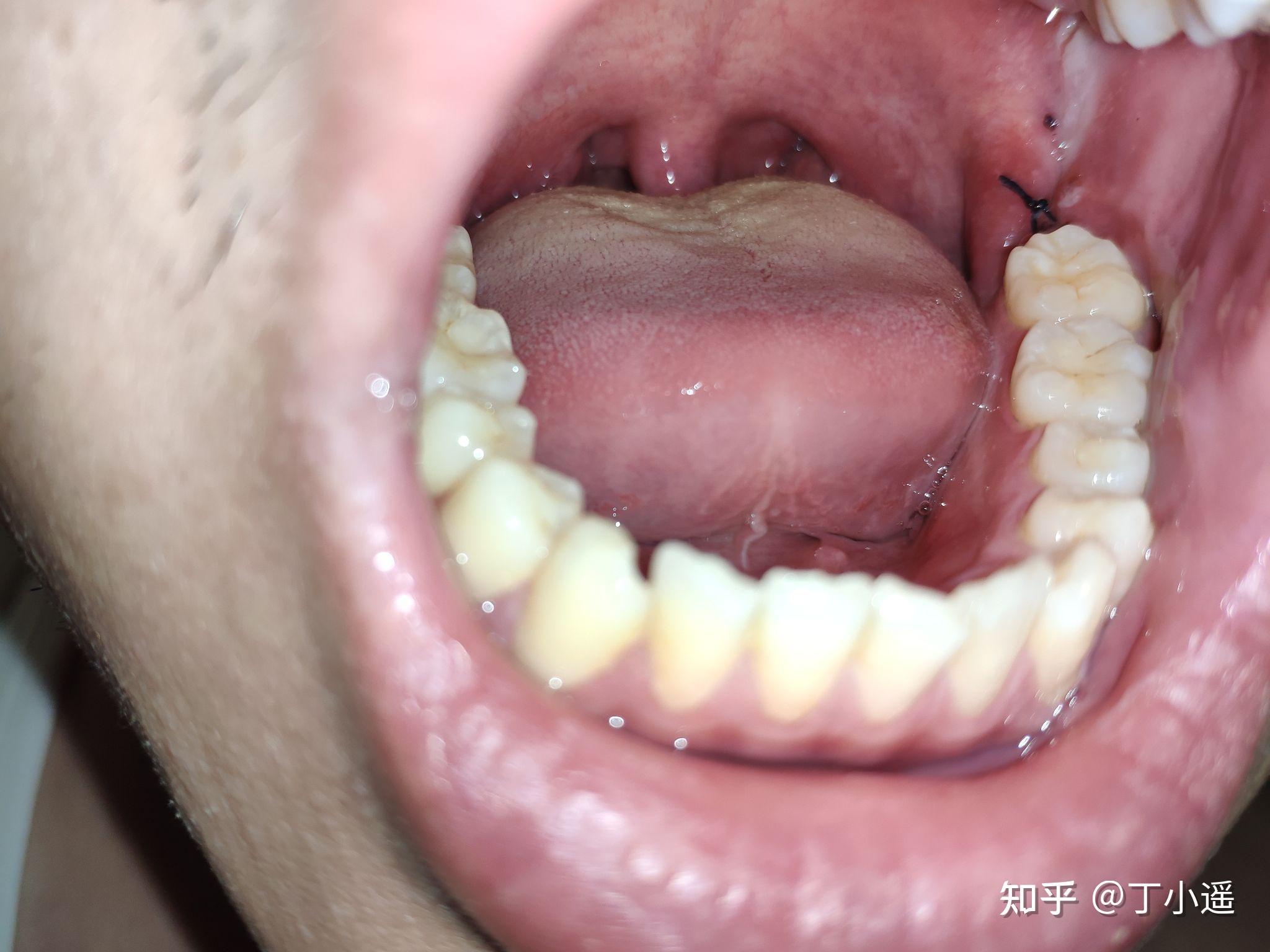 拔牙第四天,一开始的小血泡消了,虽然还是白色,但是不疼不痒,感觉应该