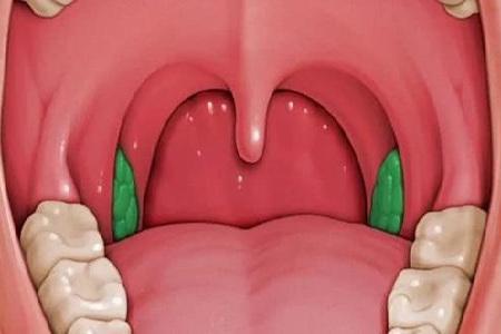 扁桃体表面有十余个隐窝腺体的开口,故外观表面不光滑,不肿大,无充血