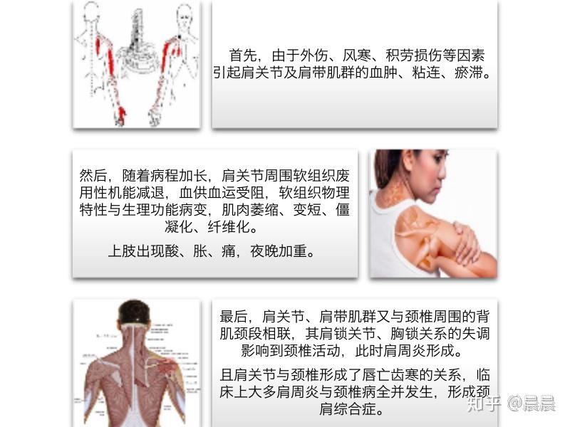 由上面的结构图可以看出,肩周炎的发病过程中会影响到上肢的肌群