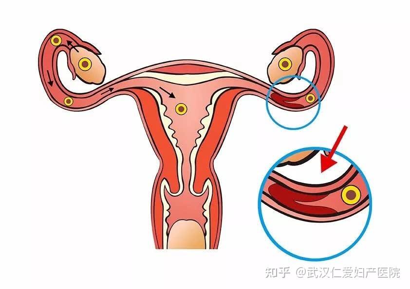 输卵管积水难孕它的危害远远比你想象的大