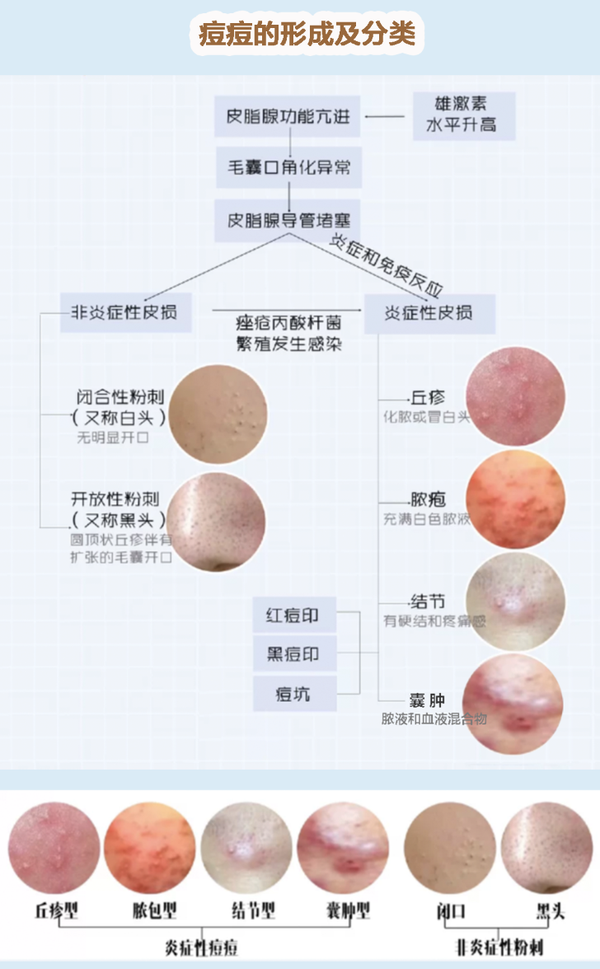 深刻解读中国痤疮治疗指南一篇带你读懂痘痘