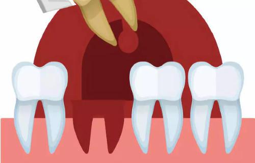 断牙残根真的非拔掉不可吗