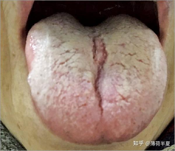 裂纹舌(2)