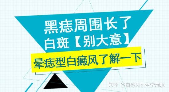 黑痣周围长了白斑别大意晕痣型白癜风了解一下