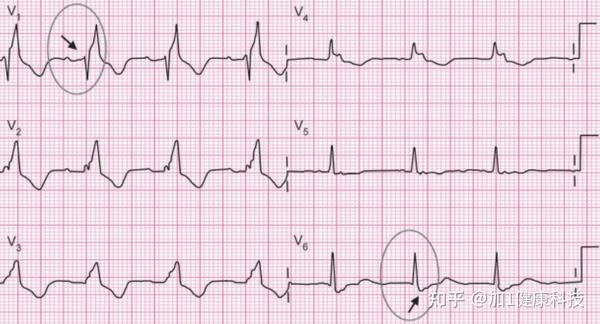 5分钟读懂心电图的9个步骤纯干货